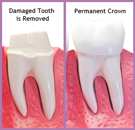 lebanon-nh-dentist-crowns